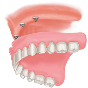 Dentures Partials – SHADOW ROCK DENTISTRY
